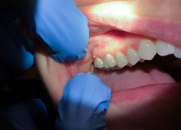 Best Dentist for Tooth Abscess  in Varnell, GA